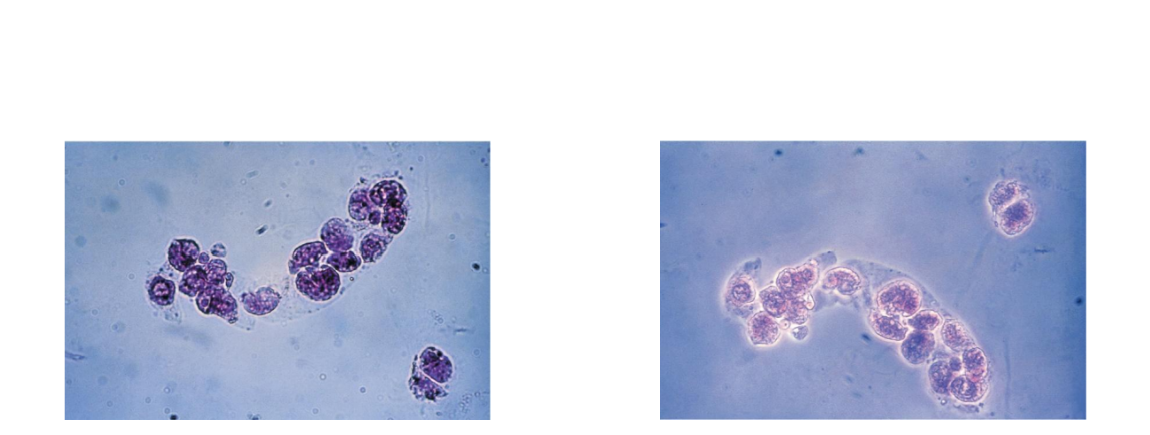 <p><span>Tubular damage, heavy</span></p><p><span>metals, viral infections,</span></p><p><span>drug toxicity, graft</span></p><p><span>rejection, pyelonephritis</span></p><p></p><p><span>Cells may appear</span></p><p><span>bilirubin stained</span></p><p></p><p><span>Look for matrix to</span></p><p><span>distinguish fragments</span></p>