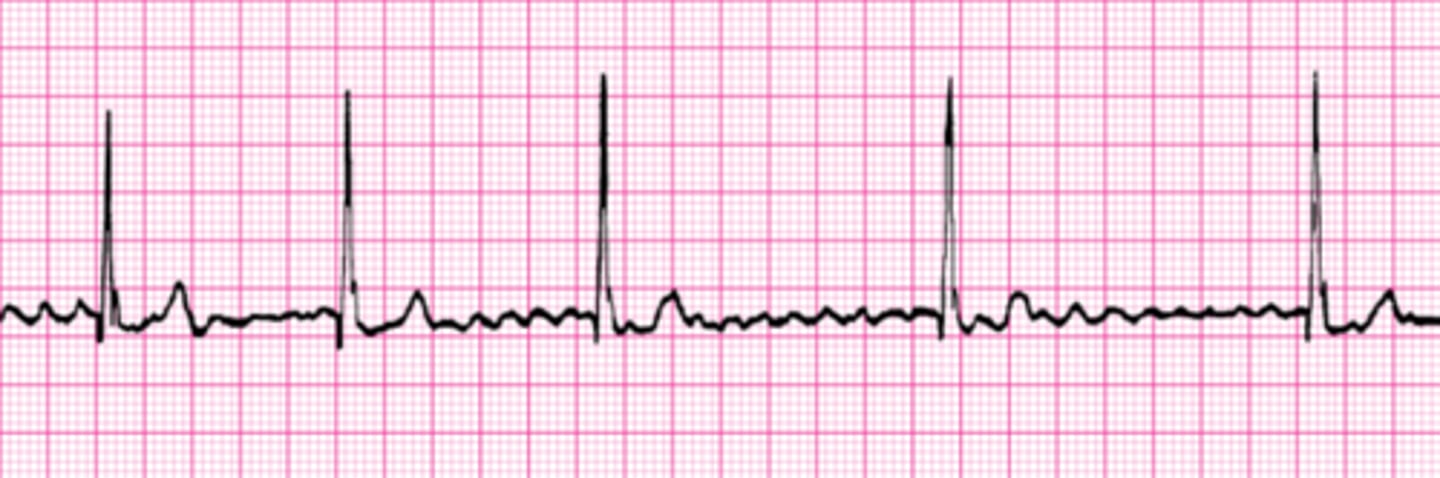 <p>Wavy and chaotic baseline, noted overall irregularity, AFib QRS complexes can be 'wide' or 'narrow'</p>