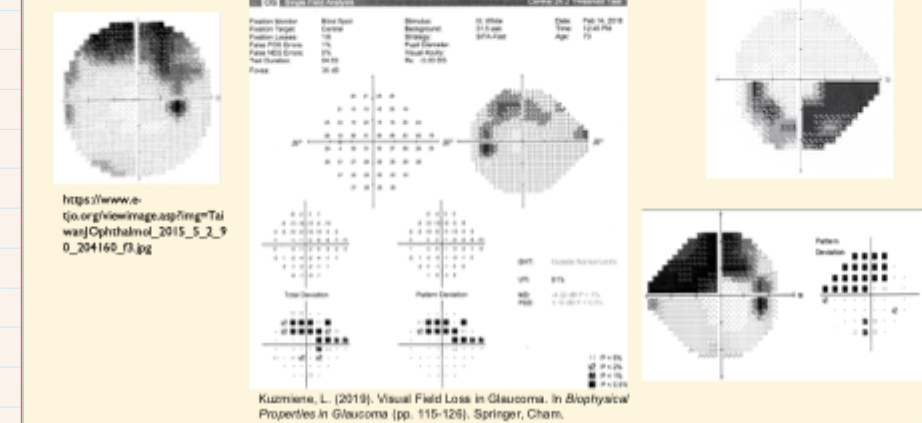 <ul><li><p>follows pattern of <strong>retinal nerve fibres</strong> (in an <u>arc</u>, radiating from disc)</p></li></ul><p></p><ul><li><p>Typical in glaucoma → obeys horizontal midline</p></li></ul><p></p>