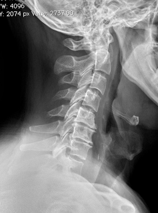 <p>Define the pathology, describe radiographic appearance and symptoms</p>