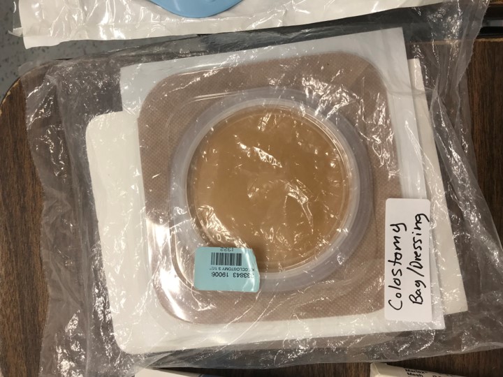 <p><span>Diseased portions of bowel are removed. The remaining portion of the bowel is rerouted by creating a hole in the abdomen (Stoma) so that the feces can exit the body and empty into the bag. May be permanent or temporary</span></p>