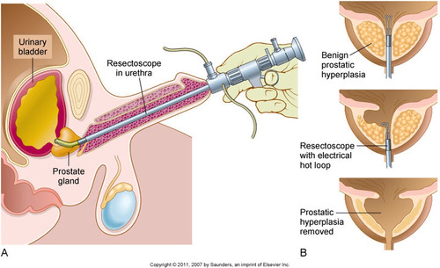 <p>transurethral resection of the prostate</p>