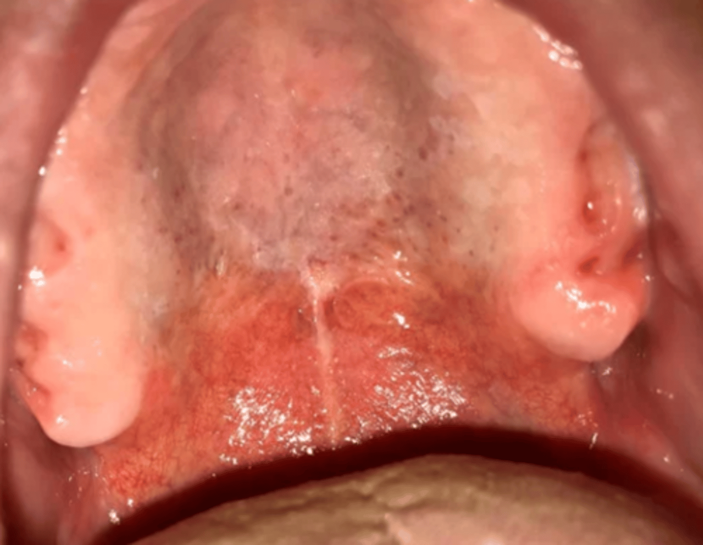 <p>Uppsvullna områden som endast ses hos aktiva rökare, ofta i kombination med en fissurerad slemhinna</p>