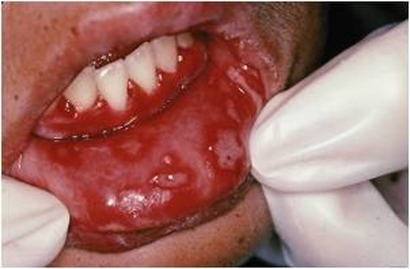 <p>Prodromal Symptoms</p><p>Vesicle Formation/Ulceration</p><p>Edematous and Erythematous Gingivae</p><p>Resent on Gingiva and Hard Palate and buccal mucosa</p>