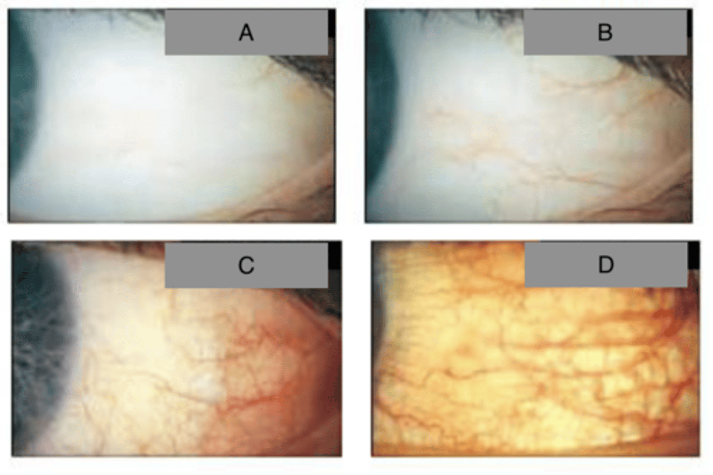 <p>Grade the following bulbar conj redness (hyperemia)</p>