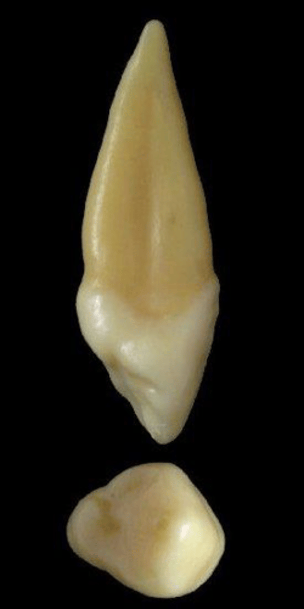 <p>what tooth is this &amp; why?</p>