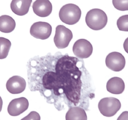 <p>has the characteristic of mostly indented or folded nucleus, sometimes vacuoles, irregular in overall shape, fine (lacy) chromatin, few granules in cytoplasm (ground glass appearance):</p>