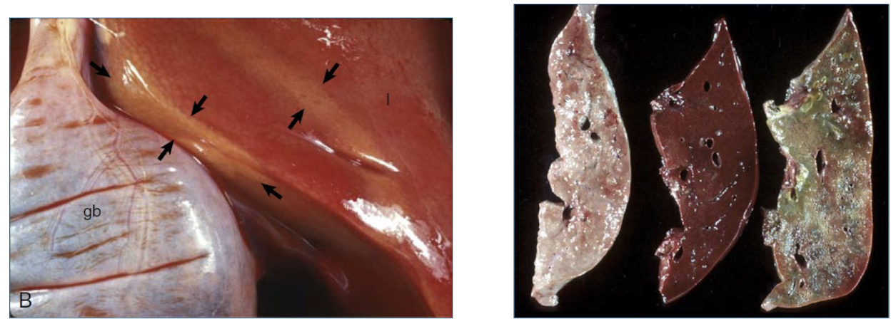 <p>greenish discoloration from leakage of bile through wall of the gallbladder or bile ducts</p>