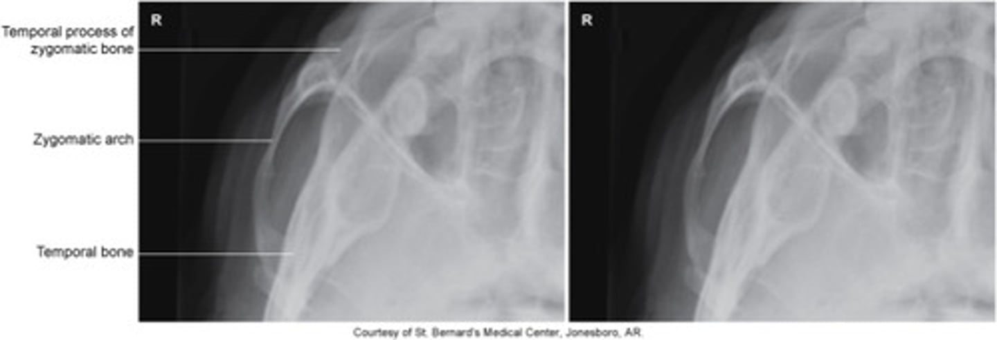<p>What is this projection?</p><p>How is Patient positing?</p><p>What is the CR?</p><p>What are the structures shown?</p>