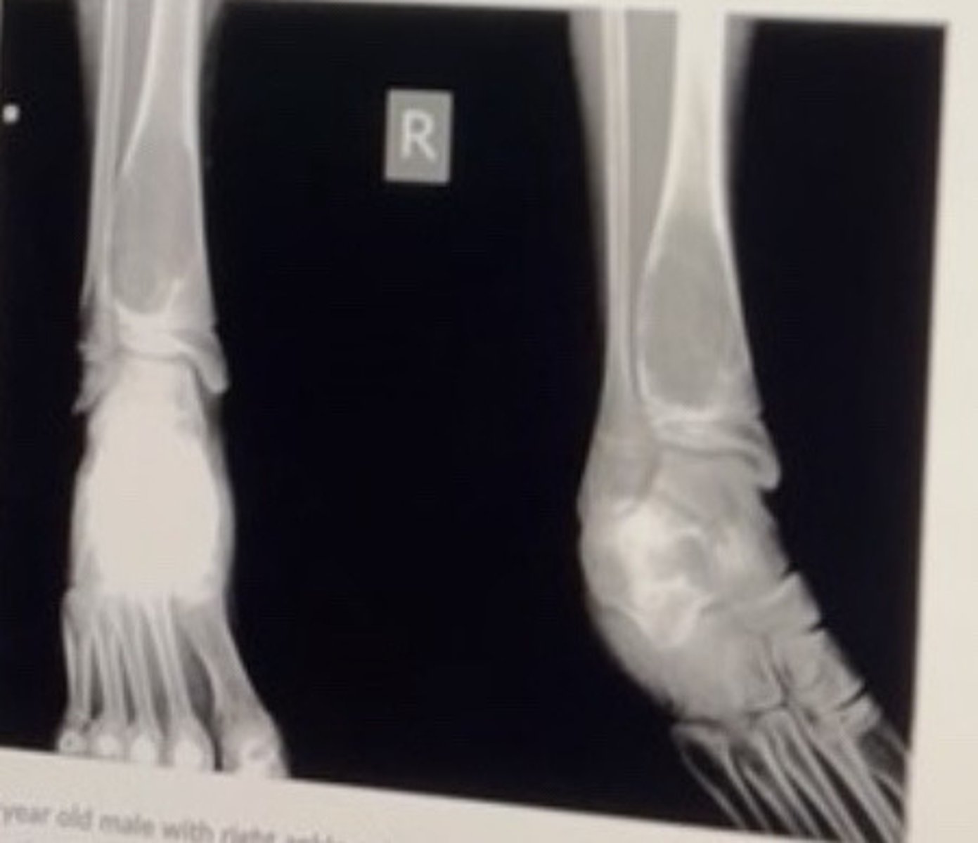 <p>13 year old male with right ankle pain and swelling of approximately 3 months duration.</p><p>Which name sign may be associated with the above condition?</p><p>• Fluid fluid sign</p><p>• Cumulus sign</p><p>• Double line sign</p><p>• Rim sign</p>