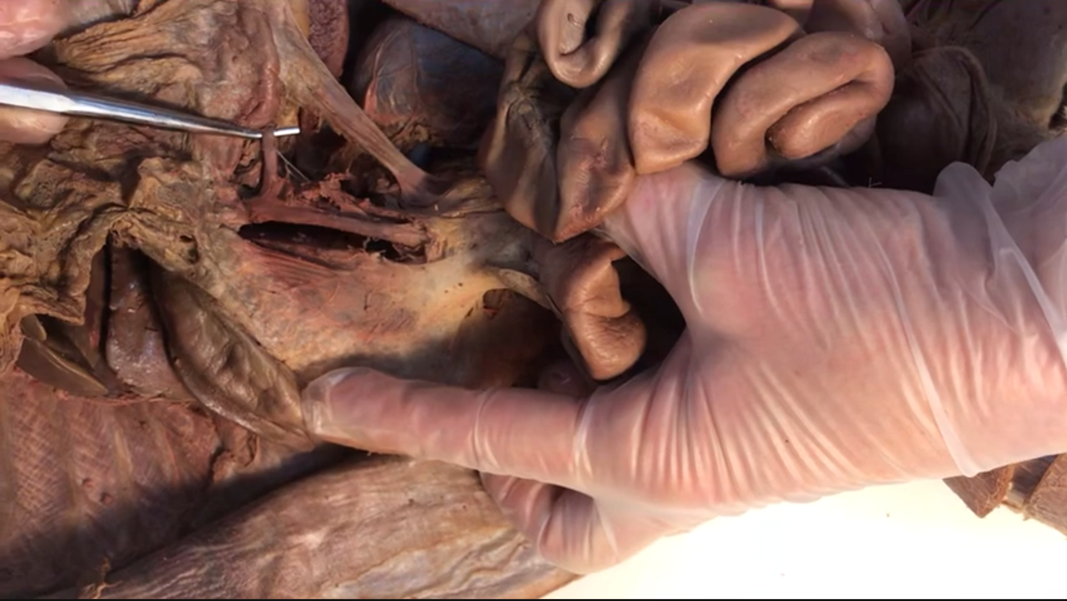 <p>What vein is this</p>