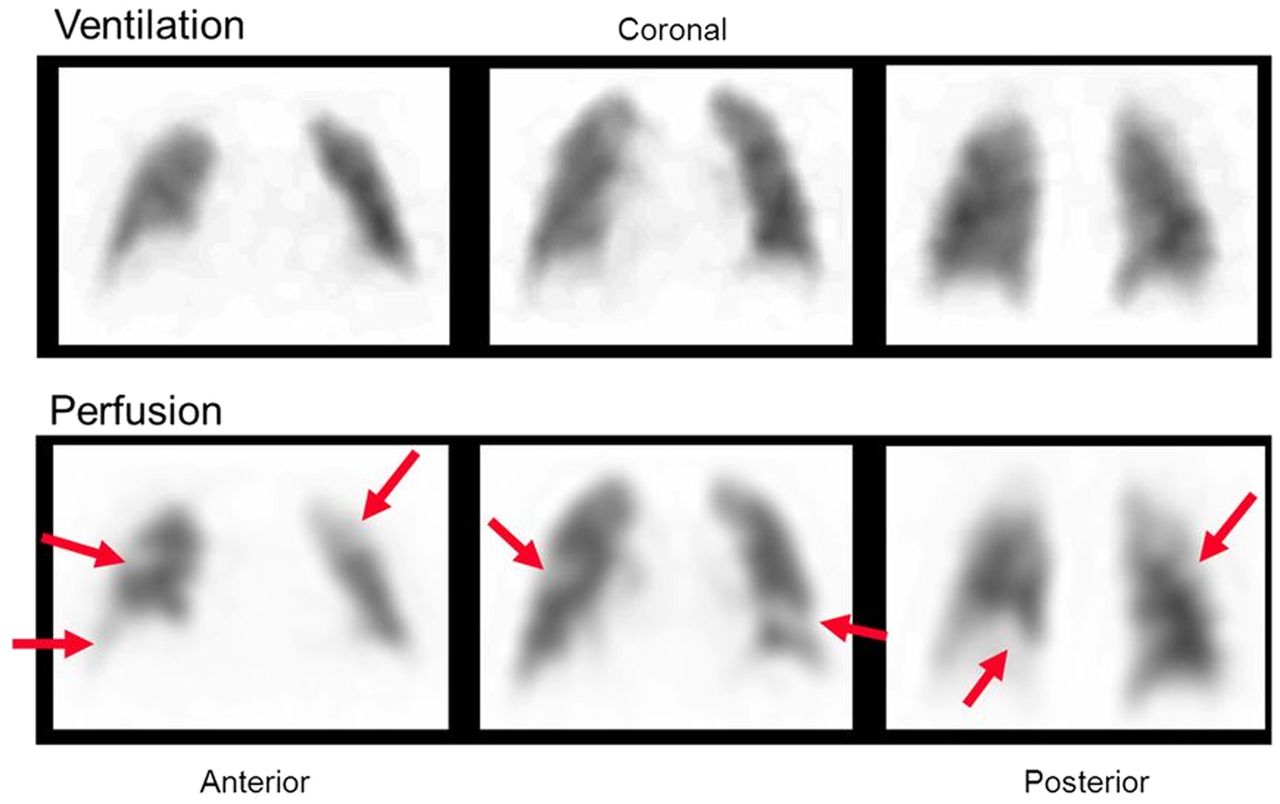 <p>Normal ventilation, perfusion defect (mismatch) </p>