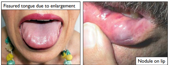 <p>thick lips (rock-solid), macroglossia </p>