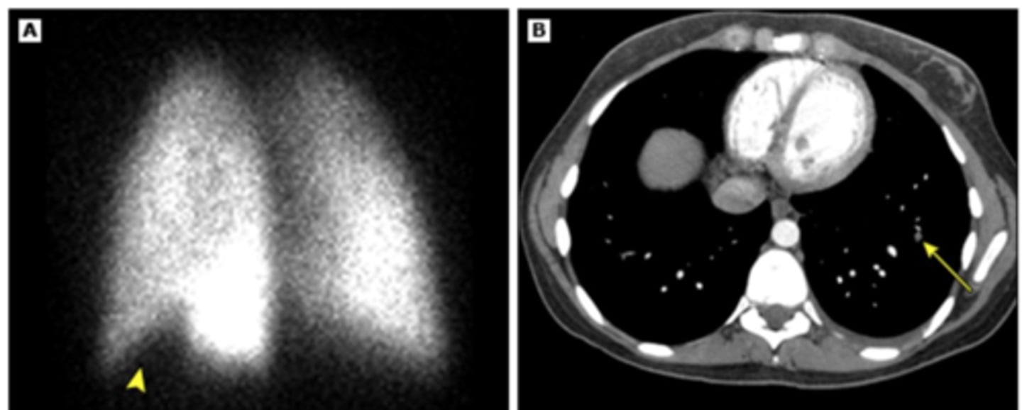 <p>V/Q scan: pt who need CTA but have contraindication to contrast dye</p>