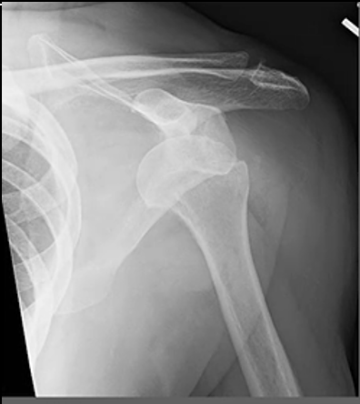 <p>A Hill-Sachs lesion, also known as a Hill-Sachs deformity, is a specific type of injury to the humerus bone (upper arm bone) that occurs in conjunction with certain shoulder dislocations. This injury is commonly associated with anterior shoulder dislocations, where the humeral head dislocates from the glenoid cavity of the scapula (shoulder blade). The Hill-Sachs lesion results from the impaction of the humeral head against the glenoid rim during the dislocation event.</p>