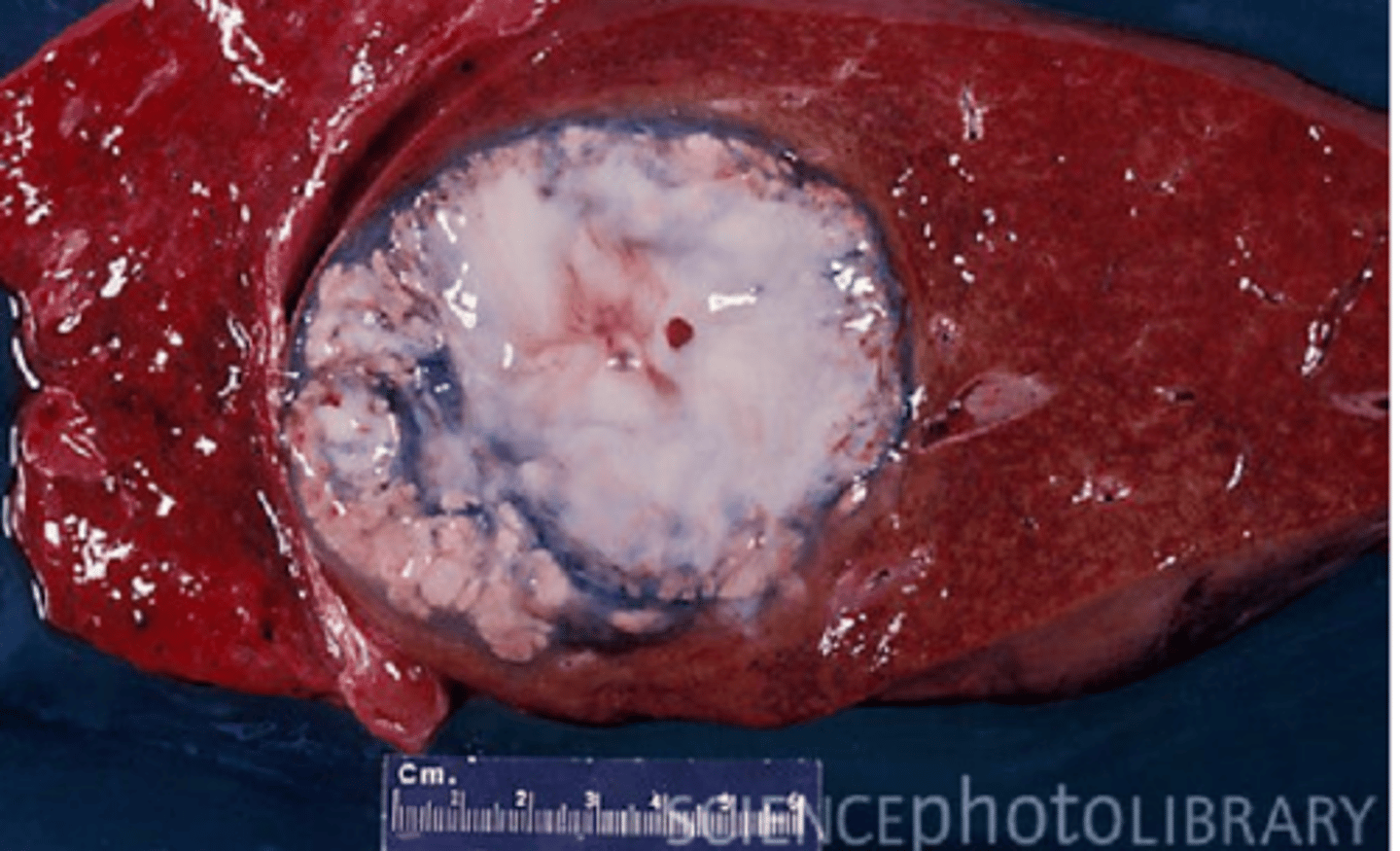 <p>what type of exudate is being depicted in the image?</p>