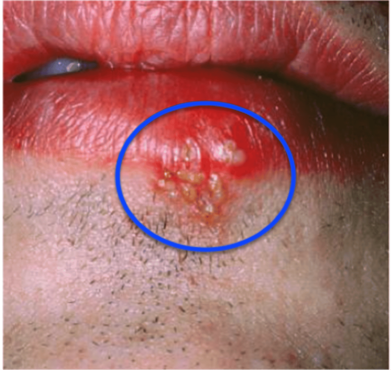 <p>Prodromal Tingling Pain</p><p>Vesicle Formation Ulceration with Crusting</p><p>anterior cervical adenopathy</p>