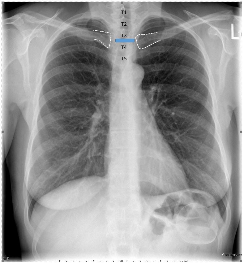 <p>At the level of the T3-T4 intervertebral disc space (T3 is acceptable).</p>