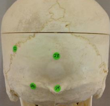 <p>#24 - forms the posterior aspect of the skull aka inion (posterior skull)</p>