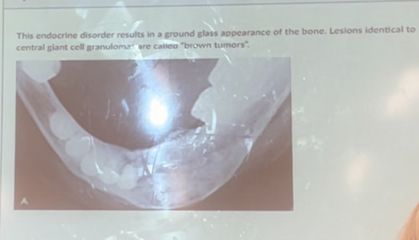 <p>The endocrine disorder results in a ground glass appearance of the bone. Lesions identical to central giant cell granuloma are called "brown tumors"</p>