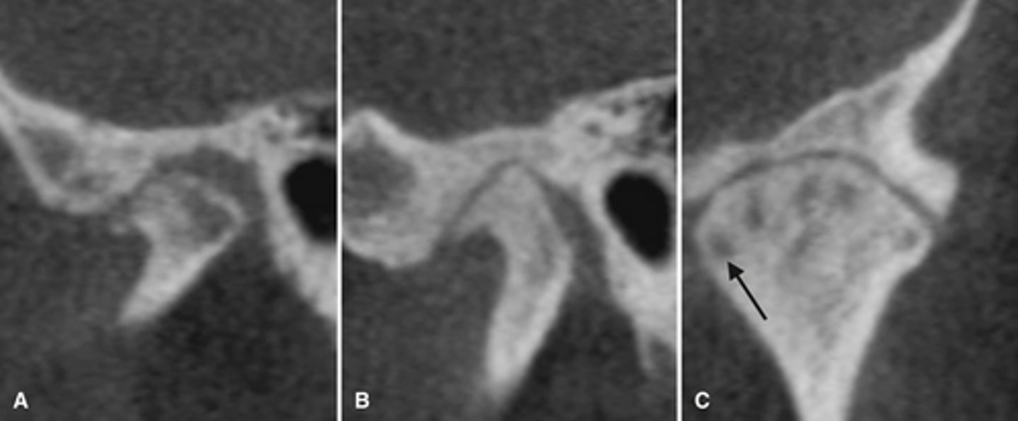 <p>What is the diagnosis of the patient based off these radiographs and what are the features?</p>