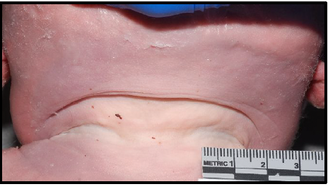 <p>umbilical cord around neck</p>