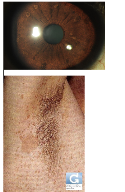 <p>what kind of genetic abnormality does this person likely have (see image)</p>