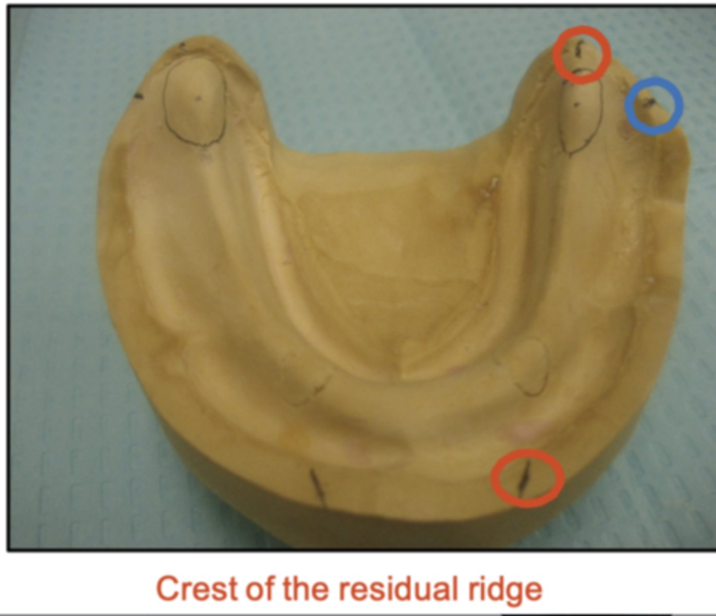 <p>It is important that we mark the crest of the mandibular ridge correctly because, if we set teeth <strong>too lingually</strong>, what would happen?</p>