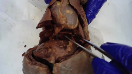 <p>Lowest lobe of the lungs</p>