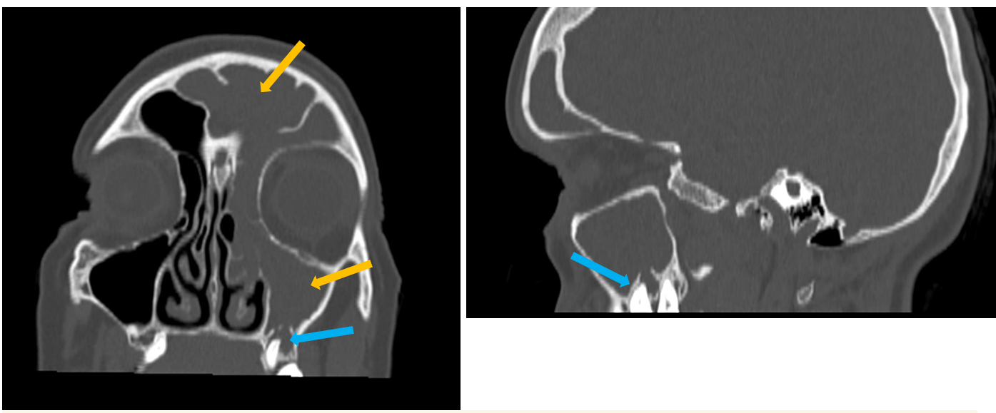 <p>Patient history: chronic headache and cough </p><p>Modality: low-dose non-contrast CT scan, coronal and sagittal reconstructions, bone window </p><p>Region: maxilla, paranasal sinuses </p><p>Radiologic sign: mucosal thickening and fluid collection in the left frontal and maxillary sinus (0-20 HU) (yellow arrows), partially filled ethmoidal cells; periapical, radiolucent area can be observed around the left upper molar tooth (blue arrow) ; normal, air-containing (-1000 HU) right maxillary sinus </p><p>Diagnosis: odontogenic sinusitis</p>