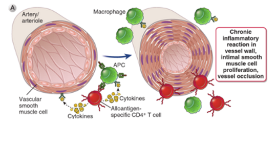 <p>Slow, ongoing immune response; <strong>both cell- and antibody-mediated mechanisms</strong> contribute.</p><p>Recipient DCs mediate slow rejection process. </p><ul><li><p><strong>Vascular changes:</strong> Intimal thickening → ischemia</p></li><li><p><strong>Fibrosis</strong> in graft tissue</p></li></ul><p></p>