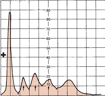 <p>Acute Inflammation</p>