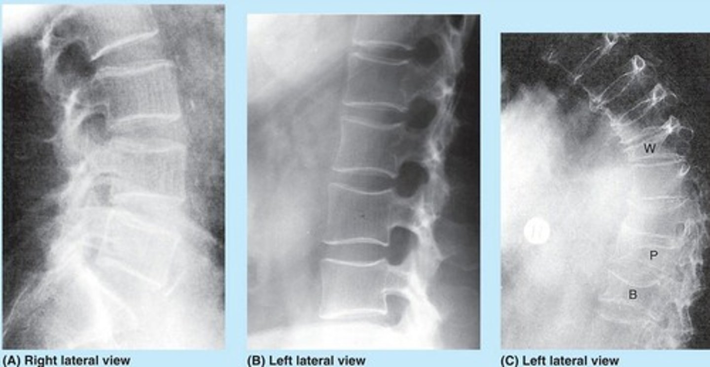 <p>Vertical striation in the vertebral bodies.</p>