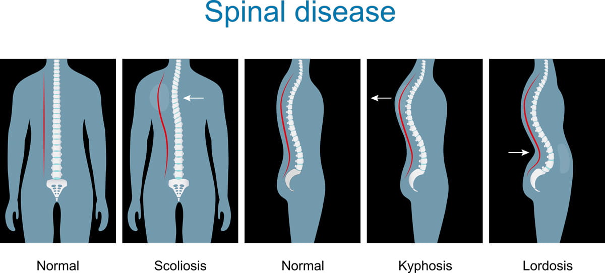 <p>an abnormally rounded upper back</p>