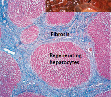 <p>Cirrhosis </p>