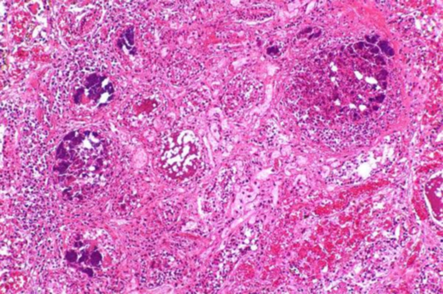 <p>what type of necrosis</p>