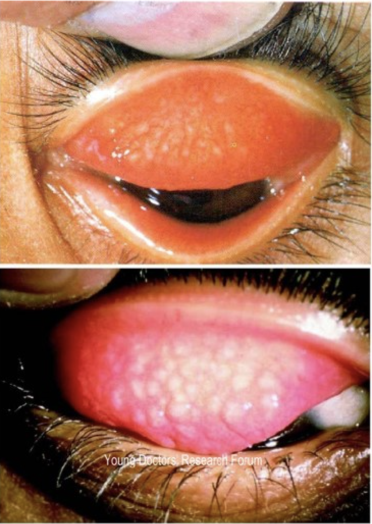 <p>what bacterial eye infection that can cause irreversible blindness is depicted in this image?</p>