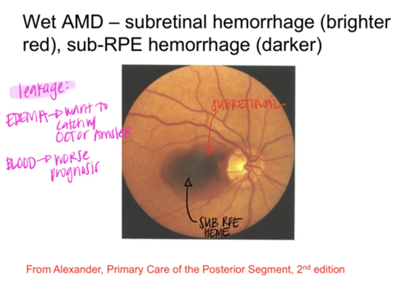 <p>Blood in the retina leads to (better/worse) prognosis</p>