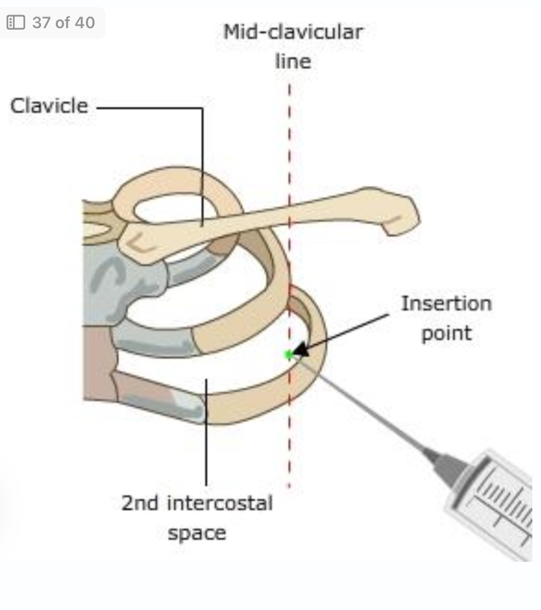 <p>Site</p><p>§ 2nd intercostal space</p><p>§ Mid-clavicular line</p><p>§ Insert just above the upper border of the <strong>lower</strong> rib (to avoid intercostal vessels)</p><p><span data-name="check_mark_button" data-type="emoji">✅</span> Used in</p><p>Clinically Stable pneumothorax</p>