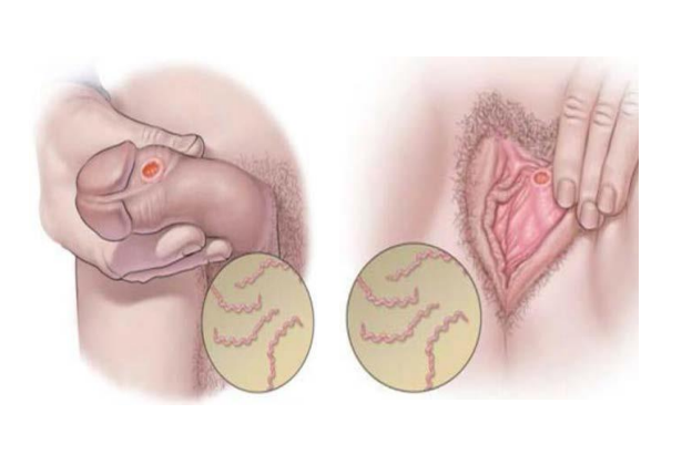 <p>Rare sexually transmitted bacterial infection</p><ul><li><p>Can cause serious damage to the body if not cured, including death.</p></li></ul>