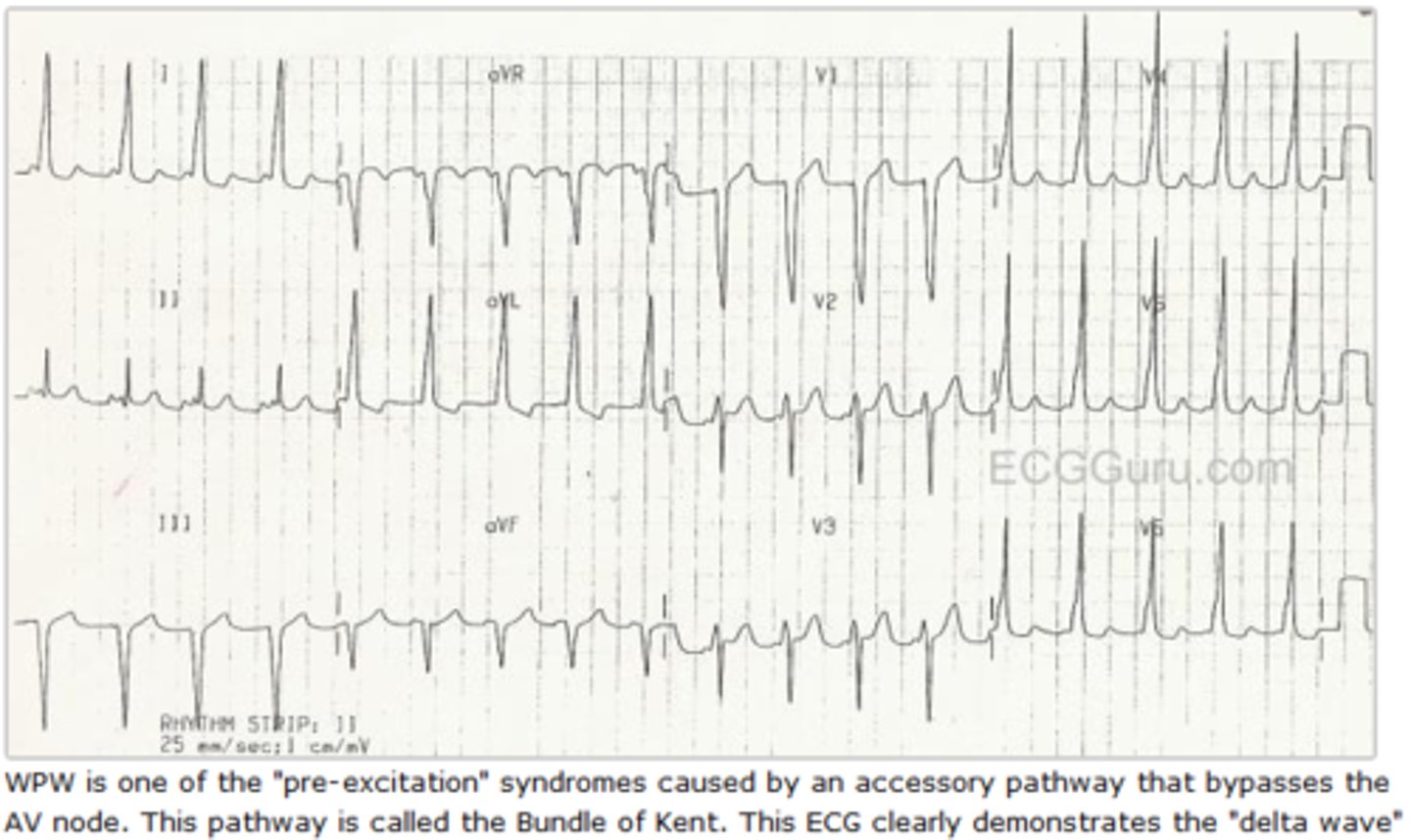 <p>Which Arrythmia is this?</p>