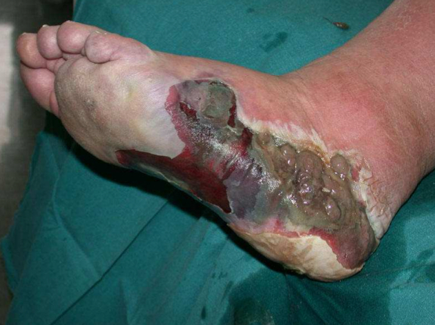<p>What is this disease called</p><img src="blob:null/389585aa-16a4-4a8f-9f7d-32513c44fa24"><img src="blob:null/c149a323-4309-4336-bfcb-945e51843226">