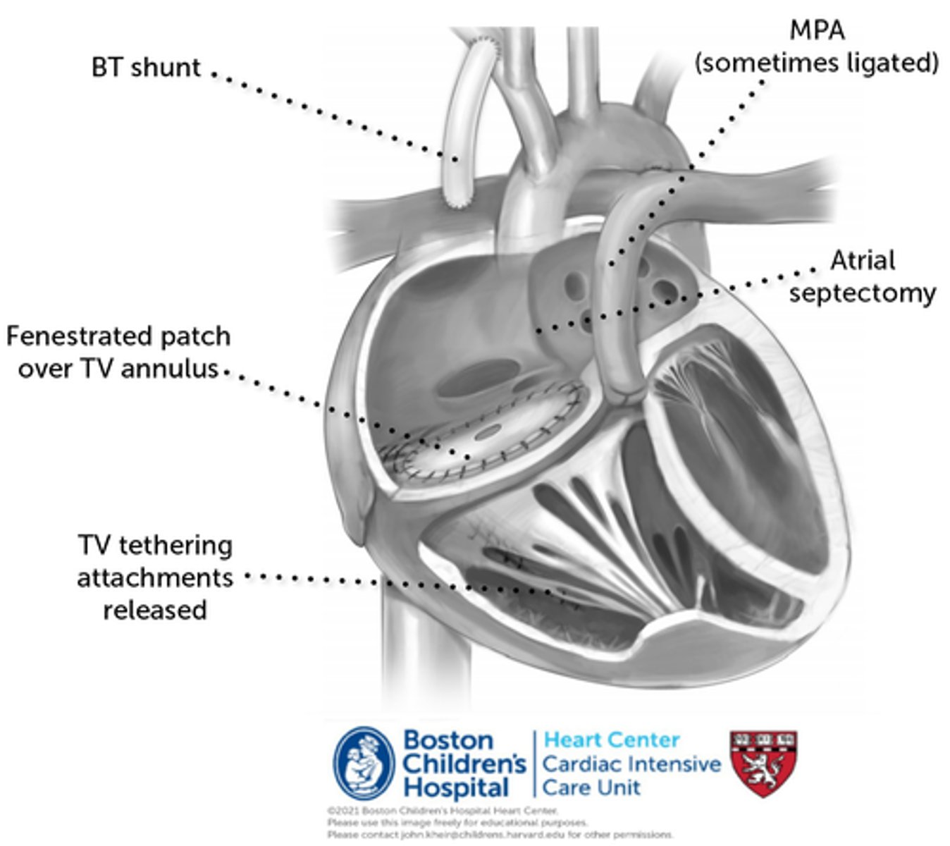 <p>Simpler option for palliation for sick baby compared to Cone procedure.</p><p>Involves patch closure of the tricuspid valve and modified BT shunt for pulmonary flow. Requires ASD.</p><p>Theoretically can be converted to a repair or replacement of TV at later point.</p>