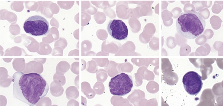 <p>malignant T cells in ____ have the following characteristics:</p><ul><li><p> abnormal appearance with scant cytoplasm and cerebriform</p></li><li><p>folded nucleus</p></li><li><p>variably condensed chromatin inconspicuous nucleoli</p></li></ul><p></p>
