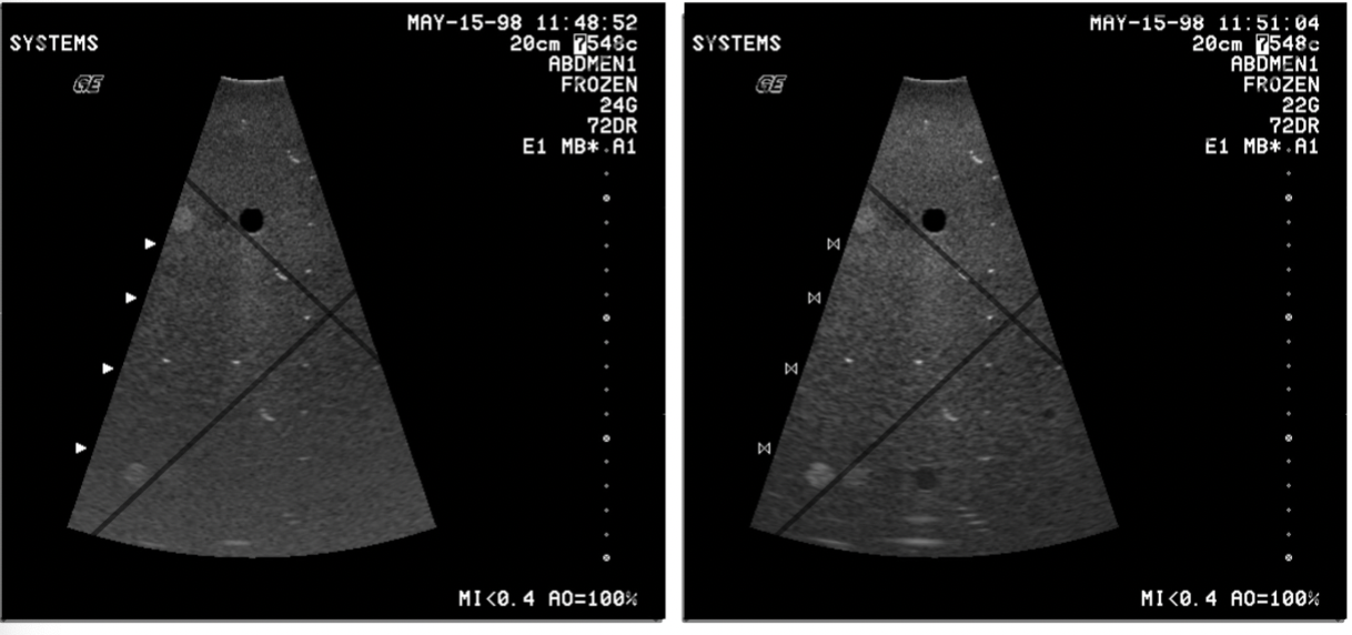 <p><strong>What is coded excitation in ultrasound, and how does it improve imaging?</strong></p>