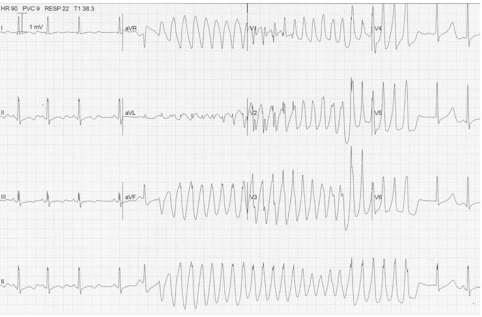 <p>What medications can we used to treat a patient in torsades as a result of long QT syndrome?</p>