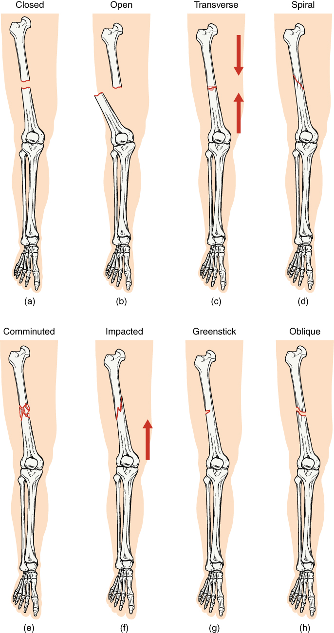 <p>break occurs perpendicular to the long axis of a bone</p><p></p>