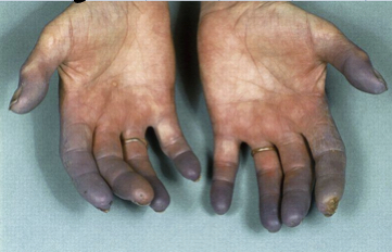Cyanosis
