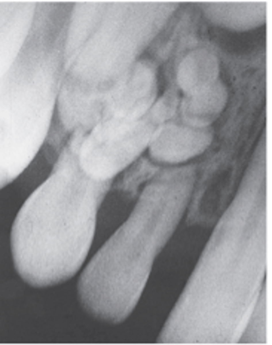 <p>-shows a collection of numerous small toothlike radiopacities surround by a radiolucent halo</p><p>-do not exhibit unlimited growth potential</p><p>-described as a developmental lesion (hamartomas) rather than true tumors</p>