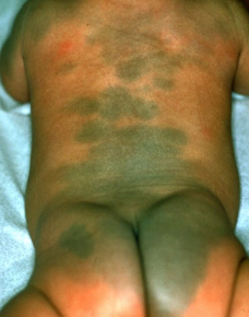 <p><strong>Mongolian Spot (Congenital Dermal Melanocytosis)</strong></p><p>-Most common in _______, AA, and Native American populations</p><p>-Results from ________ disappearance of dermal _____________</p><p>-Blue-gray, pigmented ________ or patch with ___-defined borders&nbsp;</p><ul><li><p>Most common over ________-__________ region followed by the _________</p></li></ul><p>-_______ and fades during the first couple years of life and most disappear between ages 6 and 10&nbsp;</p><p>-Don’t confuse with bruising&nbsp;</p><p></p>